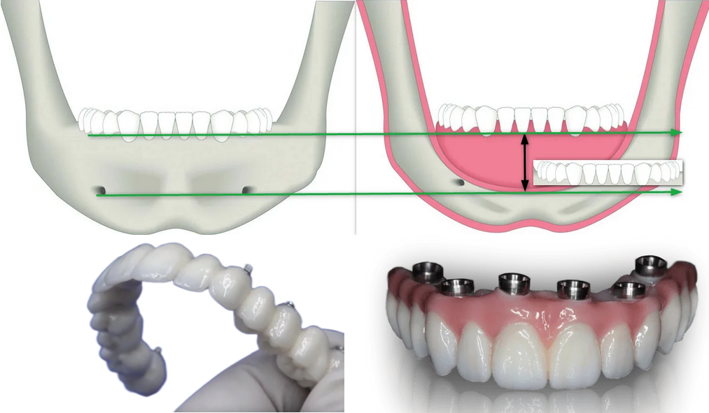 Implantologia dentale con protesi senza finta gengiva